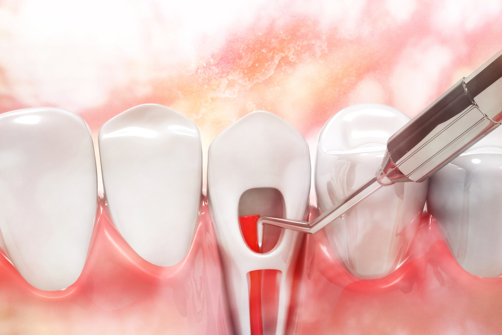 Laser-Assisted Root Canal Therapy: A New Era in Endodontics