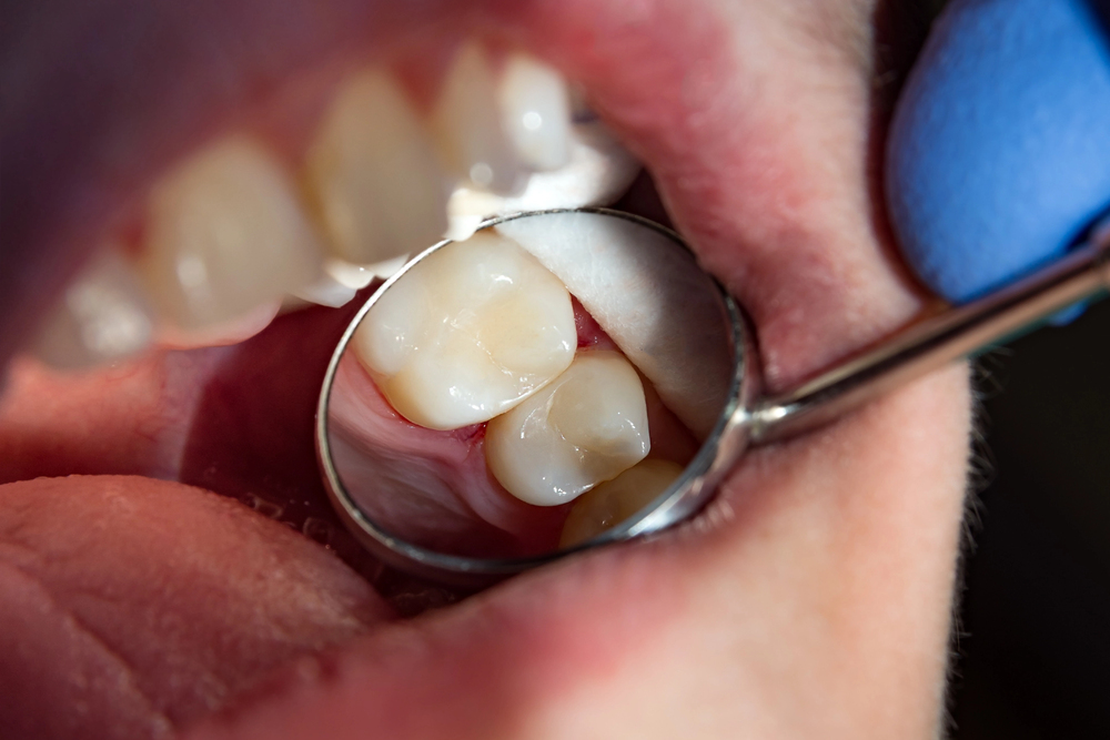 How to Prevent Cavities and Gum Disease with Simple Daily Habits