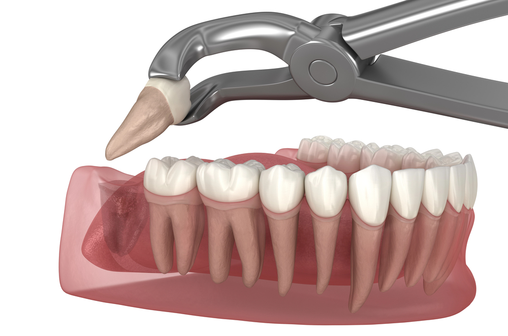 Wisdom Teeth Removal Made Safer: How Modern Technology Improves Oral Care