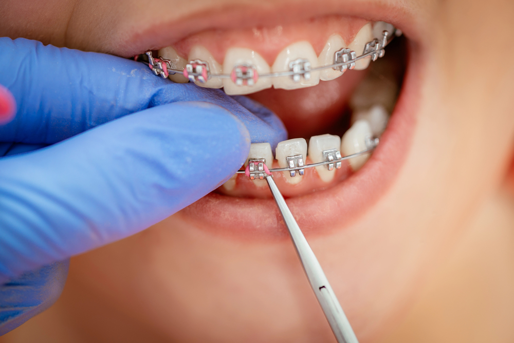braces