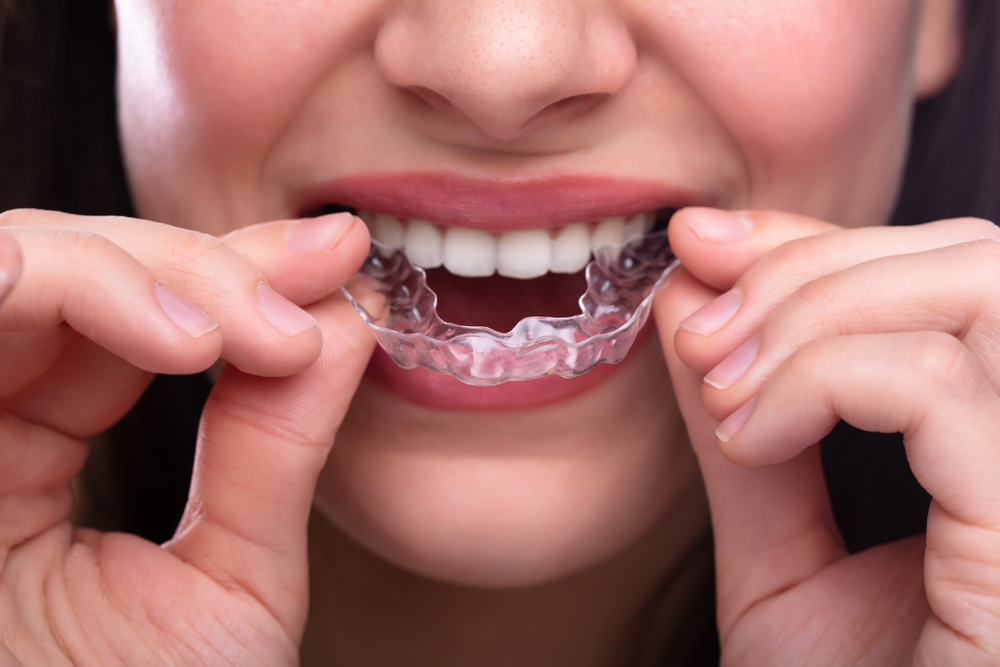Small Changes, Lasting Habits: How Clear Aligners Encourage Better Oral Care for Women